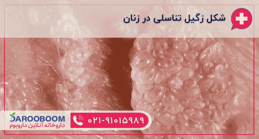شکل زگیل تناسلی در زنان