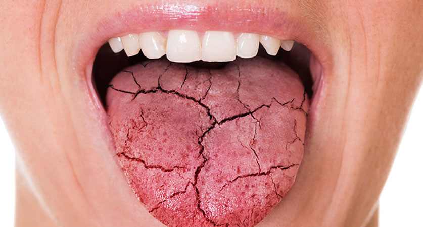 کمبود چه ویتامینی باعث خشکی دهان می شود؟