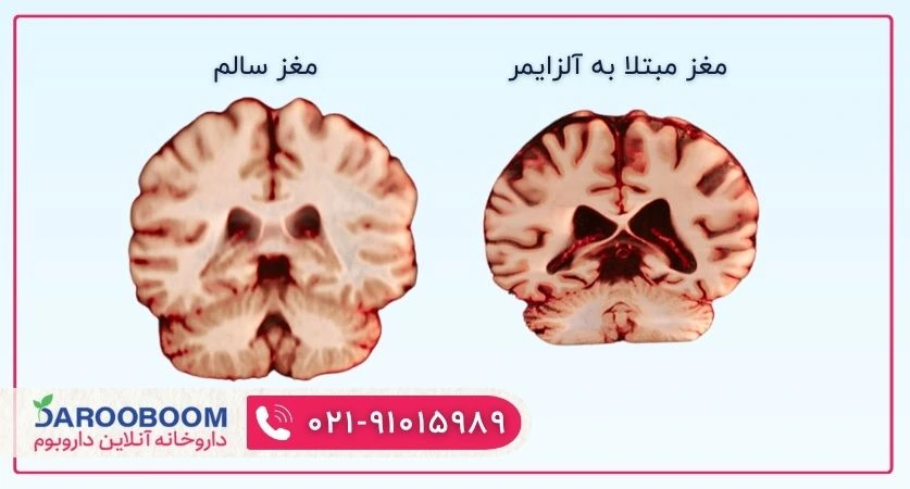 عکس بیماری آلزایمر