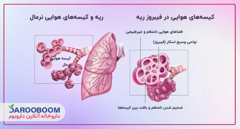 تصویر ریه نرمال در مقایسه با ریه دچار فیبروز